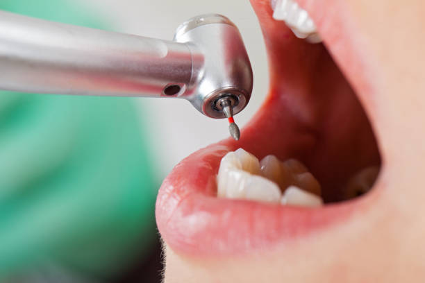 Best Emergency Wisdom Teeth Removal in Waynesburg, PA
